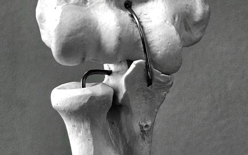 Combien de temps pour récupérer d&rsquo;une fracture de fibula ?