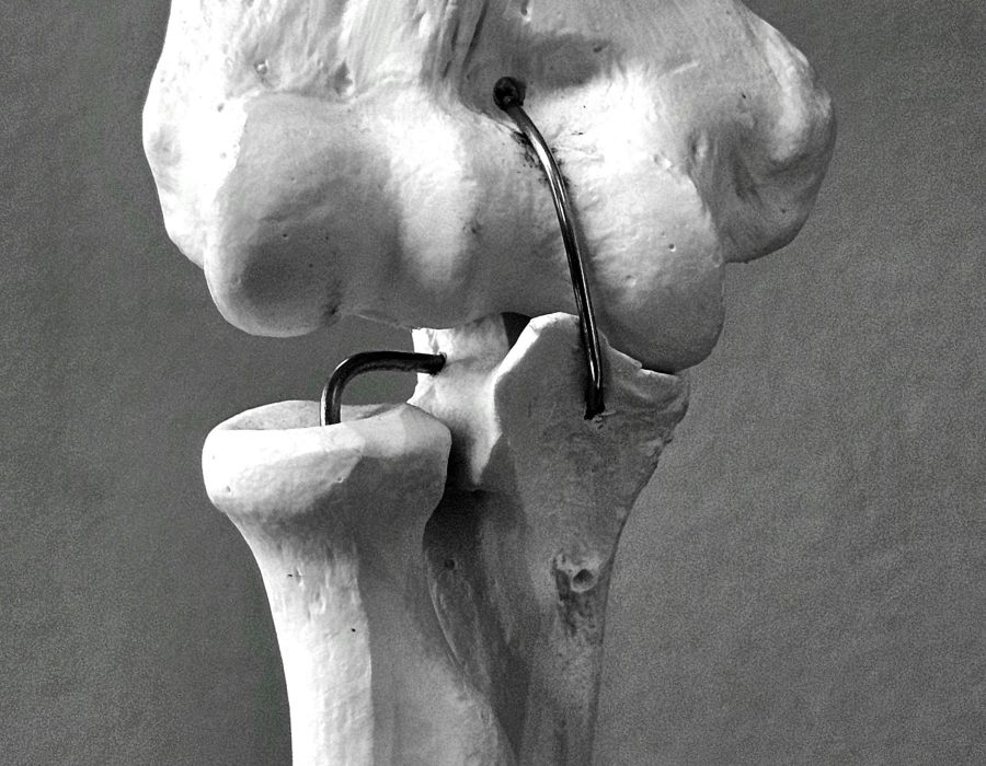 Combien de temps pour récupérer d&rsquo;une fracture de fibula ?