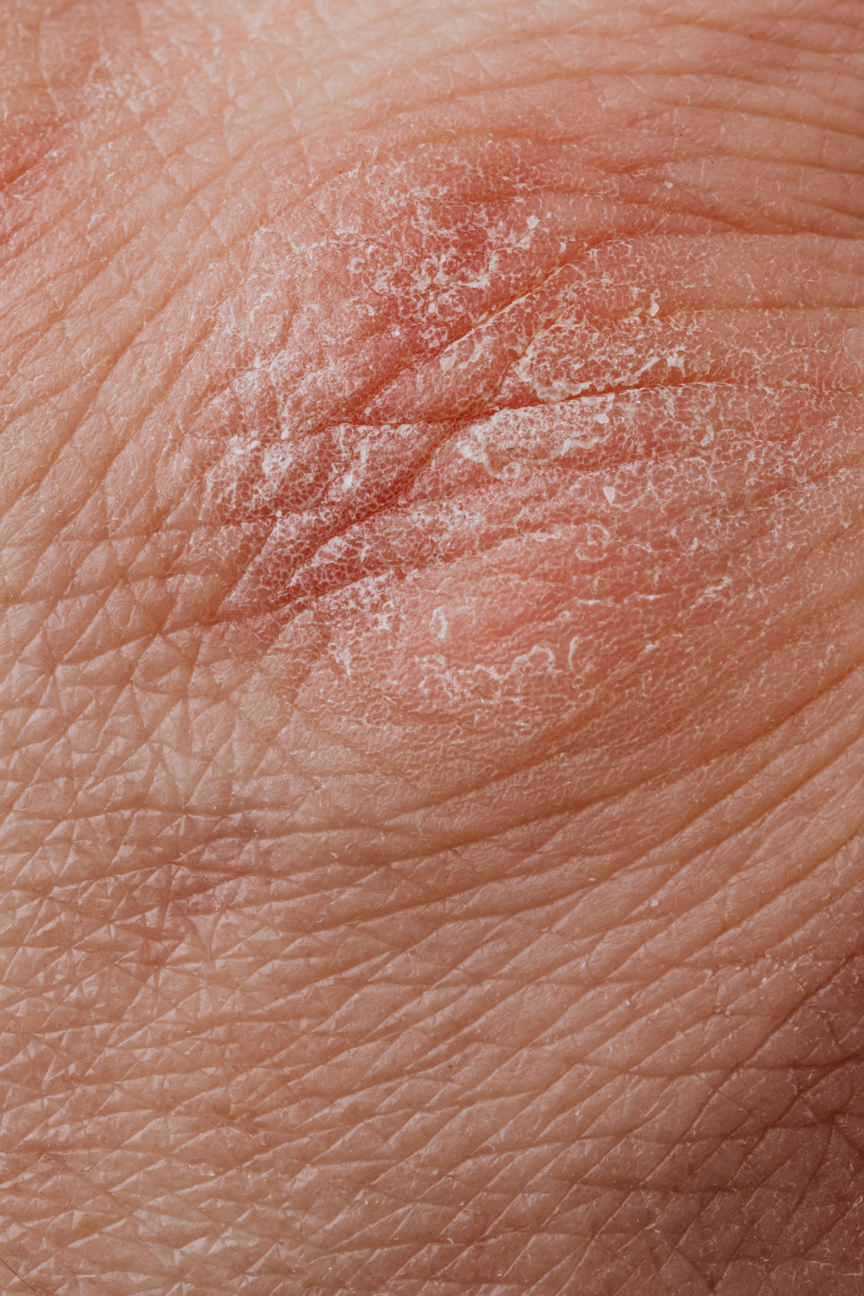 Comment traiter l'eczéma au pied