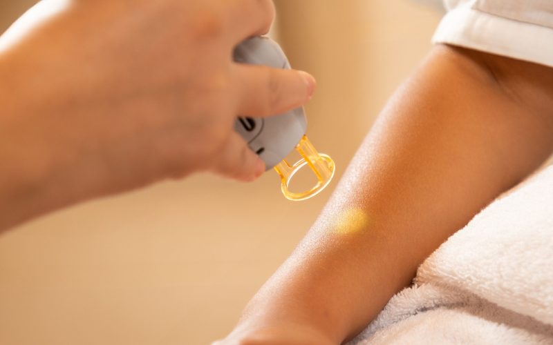 Combien de temps durent les croûtes après un laser pour taches brunes ?