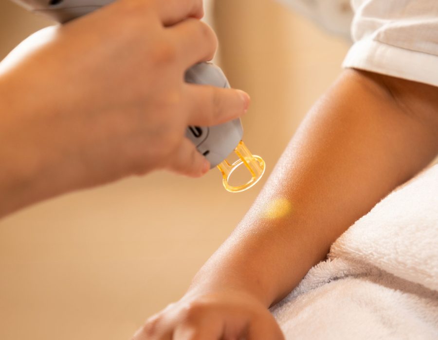 Combien de temps durent les croûtes après un laser pour taches brunes ?