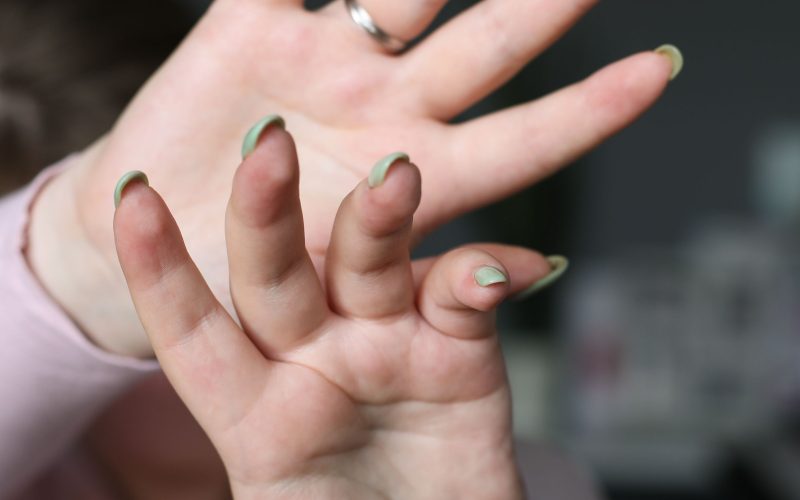 Pourquoi les vernis semi-permanents provoquent une allergie ?