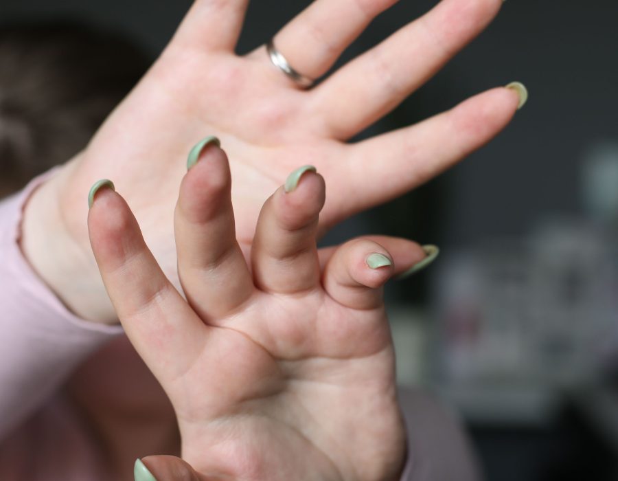 Pourquoi les vernis semi-permanents provoquent une allergie ?