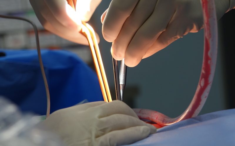 Quels sont les vrais effets secondaires du rabotage de la prostate ?