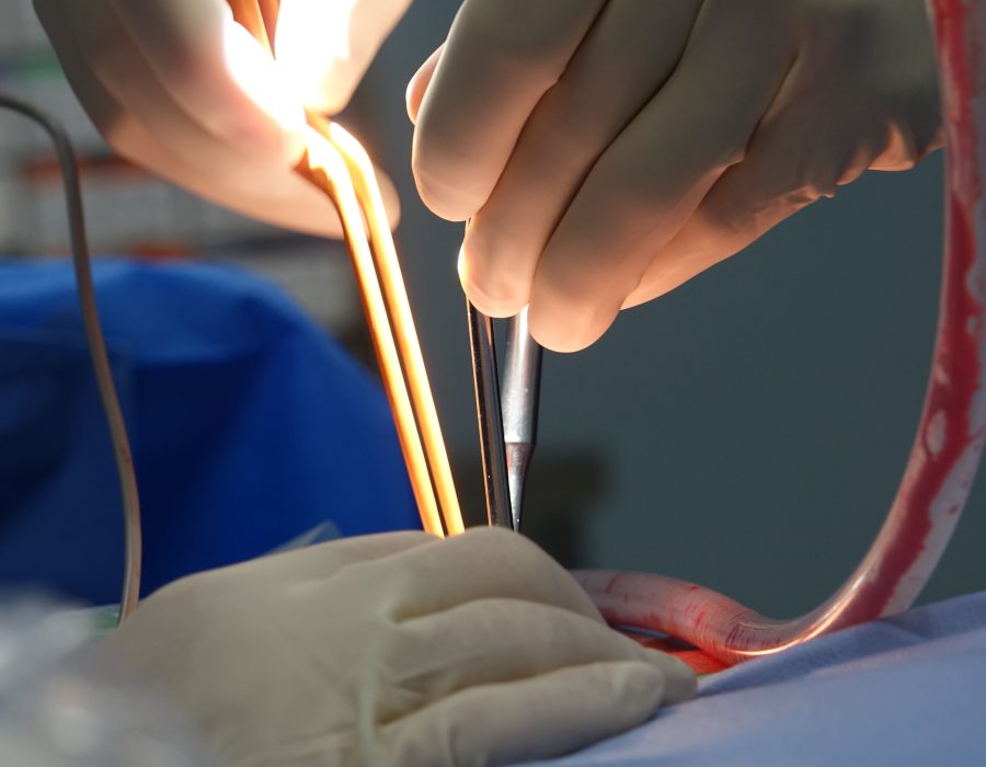 Quels sont les vrais effets secondaires du rabotage de la prostate ?