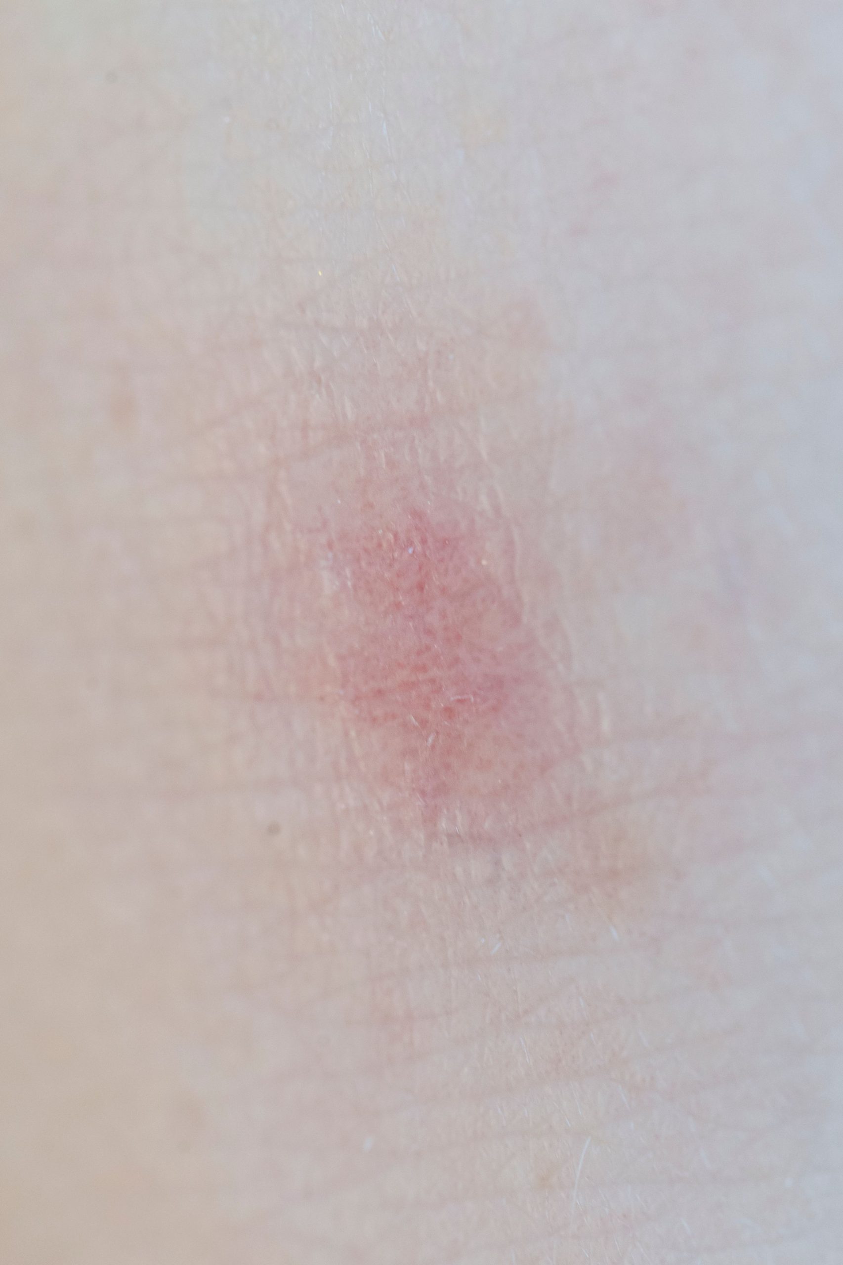 Causes de l'allergie au vernis semi-permanent