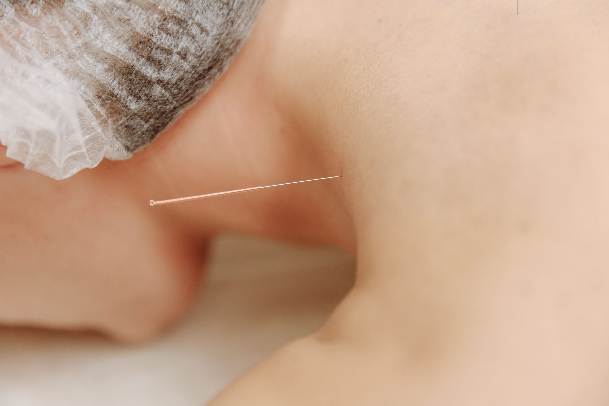 Aiguille d'acupuncture insérée dans la peau