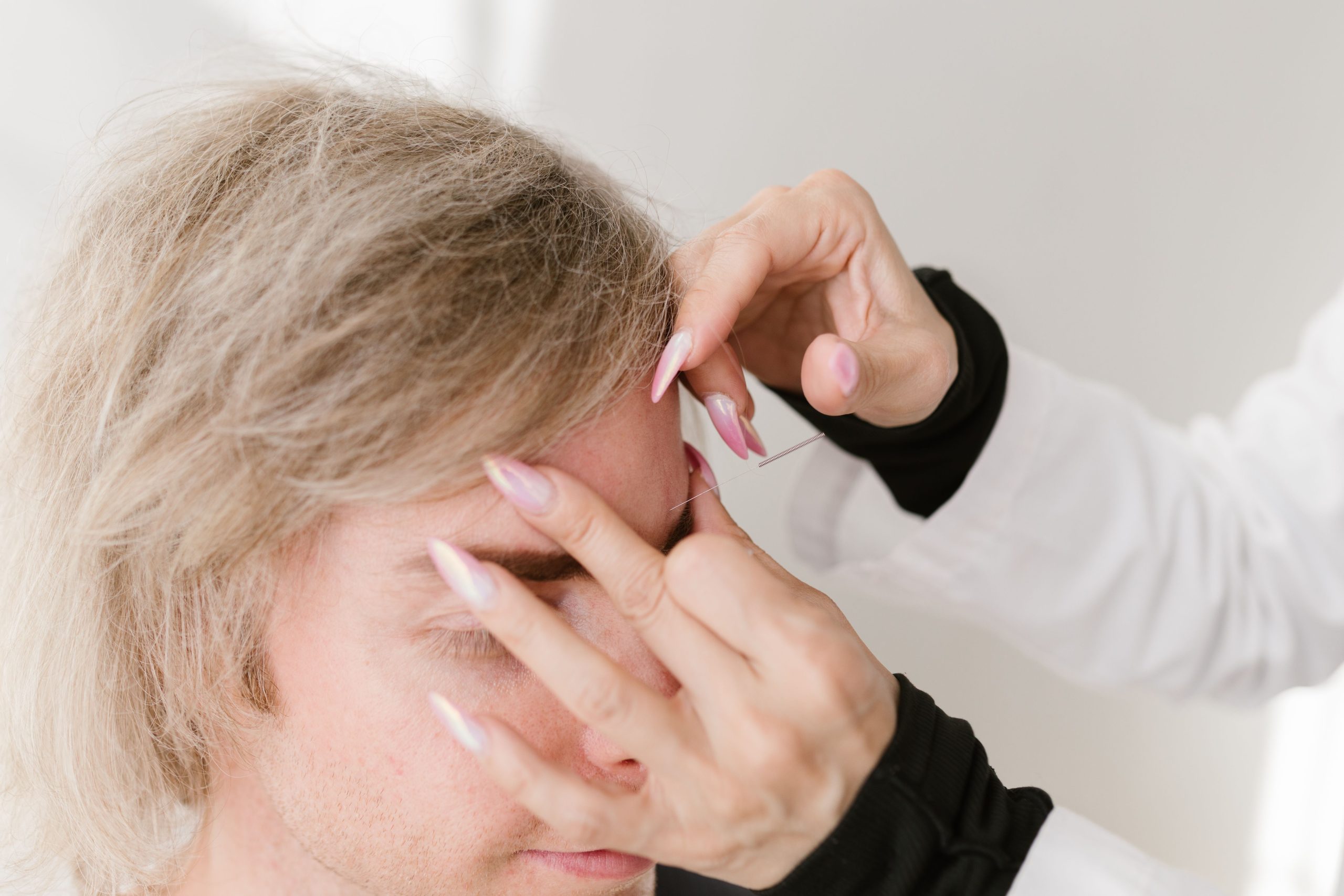 Séance d'acupuncture thérapeutique pour bien-être
