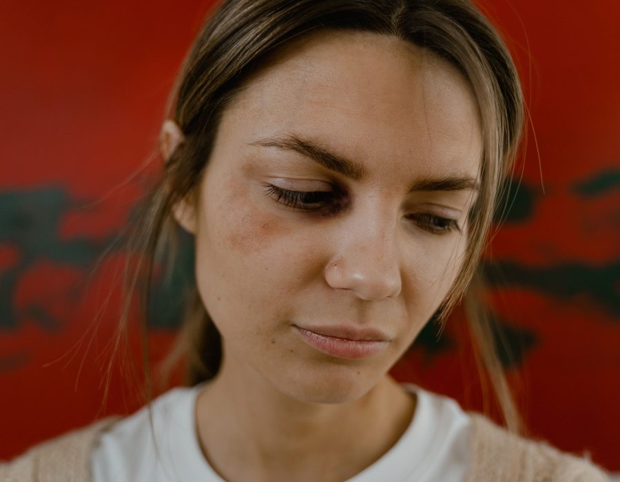 Allergie aux yeux, le gonflement dure combien de temps ?